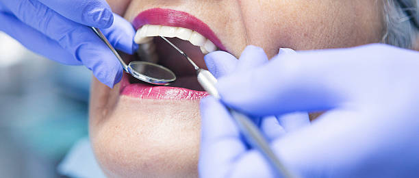 Best Emergency Tooth Extraction in Squaw Valley, CA